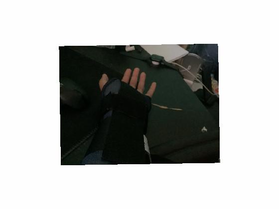 sprained wrist